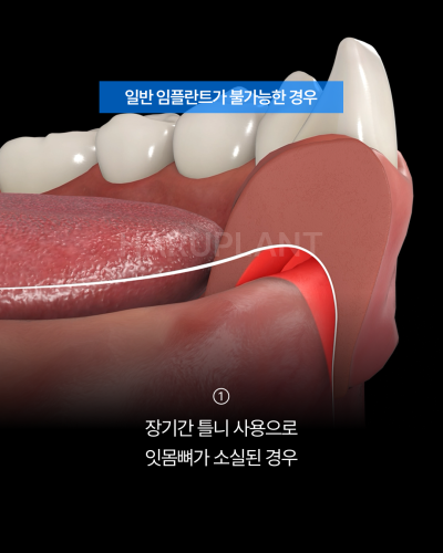 올온엑스 임플란트, 전악 임플란트가 어렵다고 들은 경우에도 고려할 수 있는 이유는? 사진 3