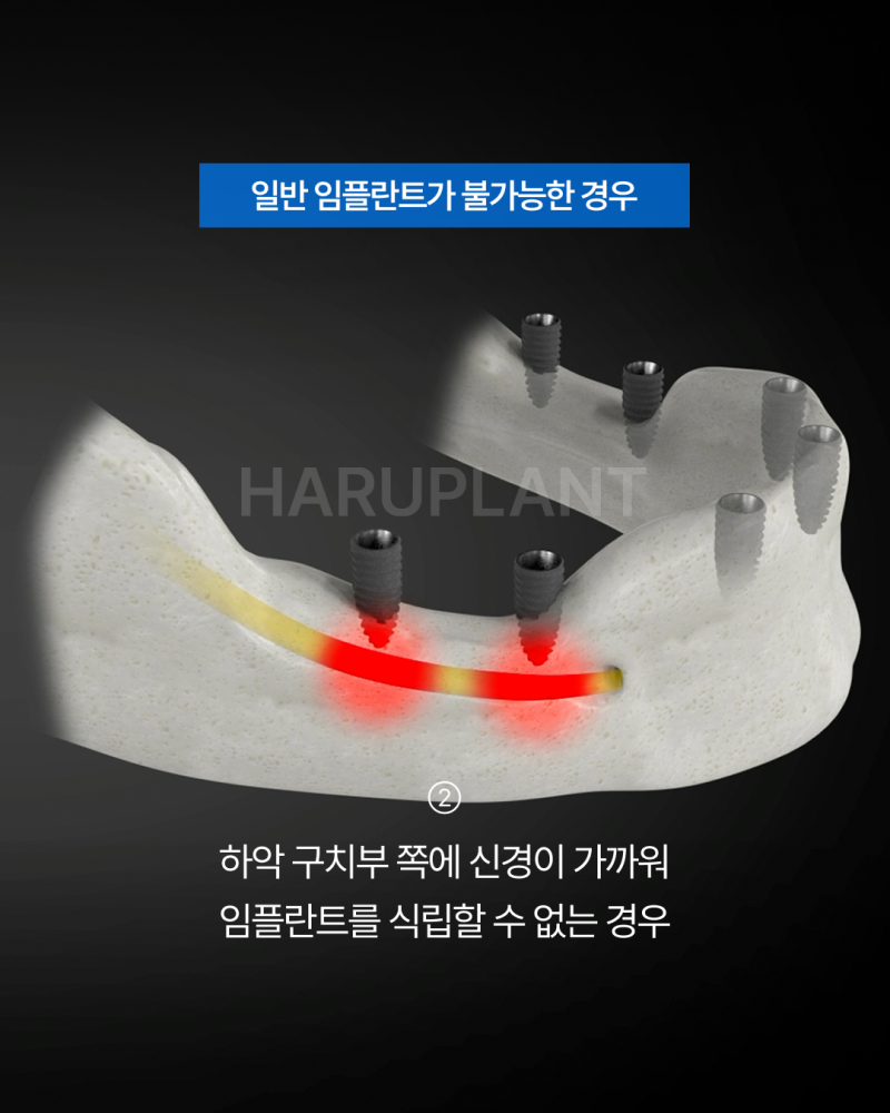 올온엑스 임플란트, 전악 임플란트가 어렵다고 들은 경우에도 고려할 수 있는 이유는? 사진 4