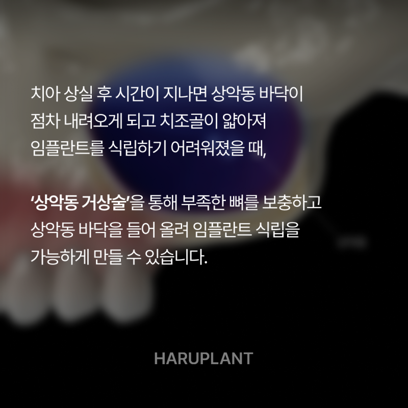 상악동거상술 뜻과 종류로 알아보는 위턱 어금니가 고난도임플란트가 되는 이유 사진 3