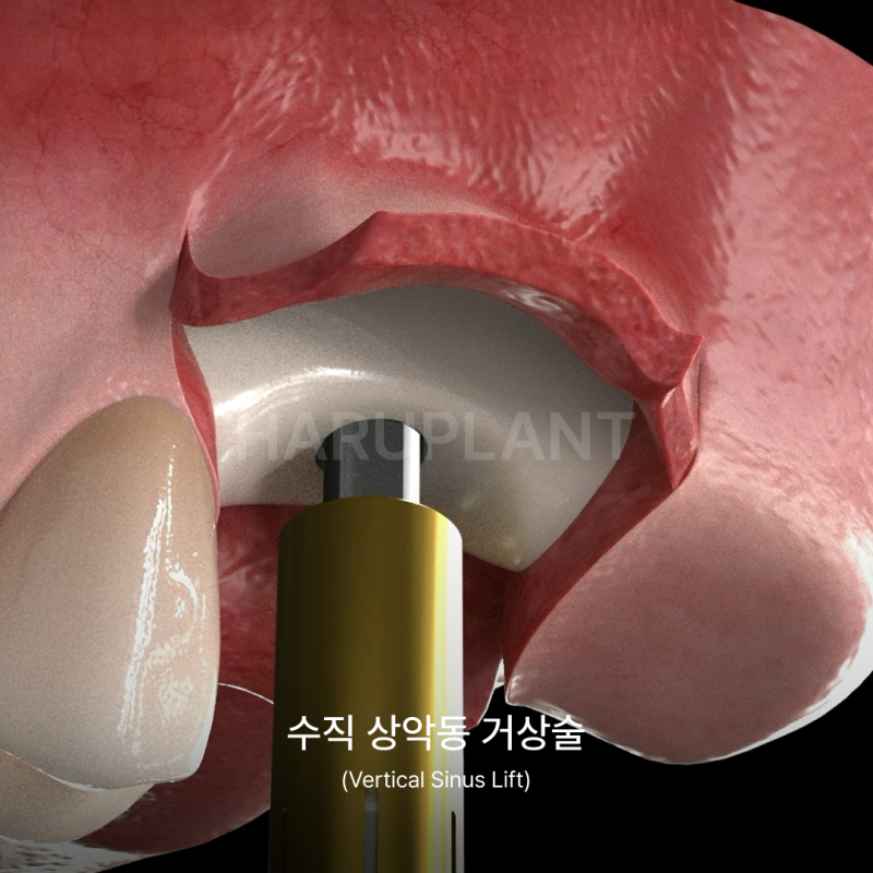 상악동거상술 뜻과 종류로 알아보는 위턱 어금니가 고난도임플란트가 되는 이유 사진 7