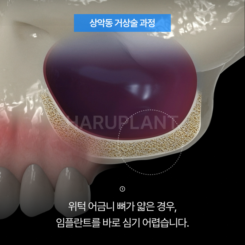 상악동거상술 뜻과 종류로 알아보는 위턱 어금니가 고난도임플란트가 되는 이유