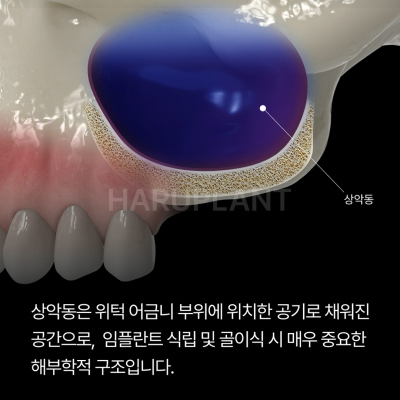 상악동거상술 뜻과 종류로 알아보는 위턱 어금니가 고난도임플란트가 되는 이유 사진 2