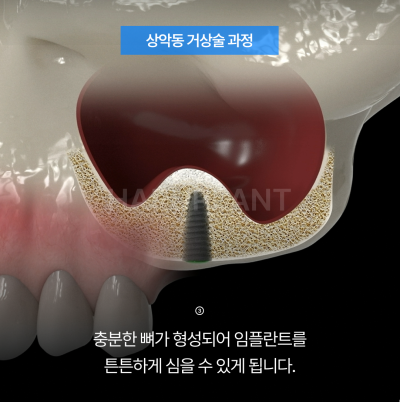 상악동거상술 뜻과 종류로 알아보는 위턱 어금니가 고난도임플란트가 되는 이유 사진 6