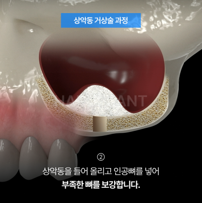 상악동거상술 뜻과 종류로 알아보는 위턱 어금니가 고난도임플란트가 되는 이유 사진 5