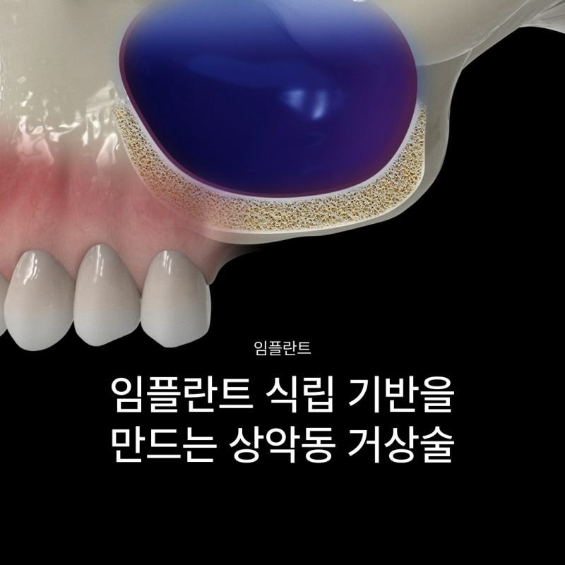 상악동거상술 뜻과 종류로 알아보는 위턱 어금니가 고난도임플란트가 되는 이유
