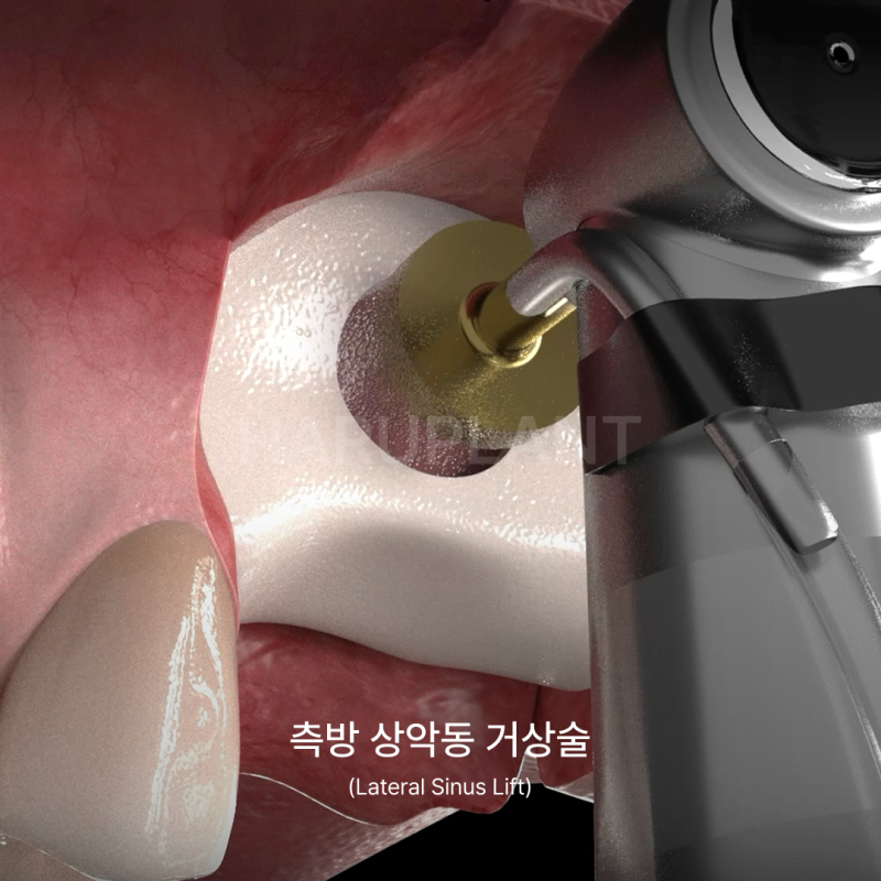 상악동거상술 뜻과 종류로 알아보는 위턱 어금니가 고난도임플란트가 되는 이유 사진 8