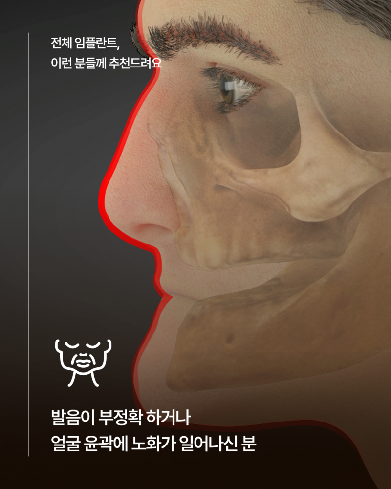 65세이상임플란트 중 무치악에 해당한다면, 전체임플란트가 필요한지 먼저 확인하세요! 사진 6