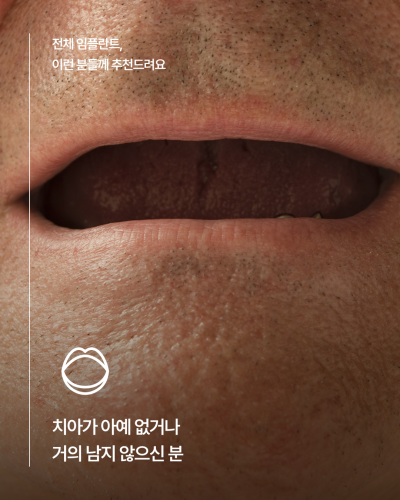 65세이상임플란트 중 무치악에 해당한다면, 전체임플란트가 필요한지 먼저 확인하세요!