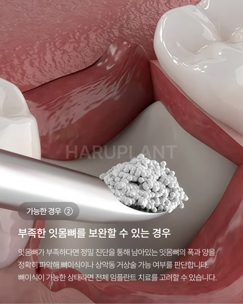 오랜 틀니 사용 후 전체 임플란트가 가능한 경우, 임플란트 종류와 전체 임플란트 뜻까지 사진 4