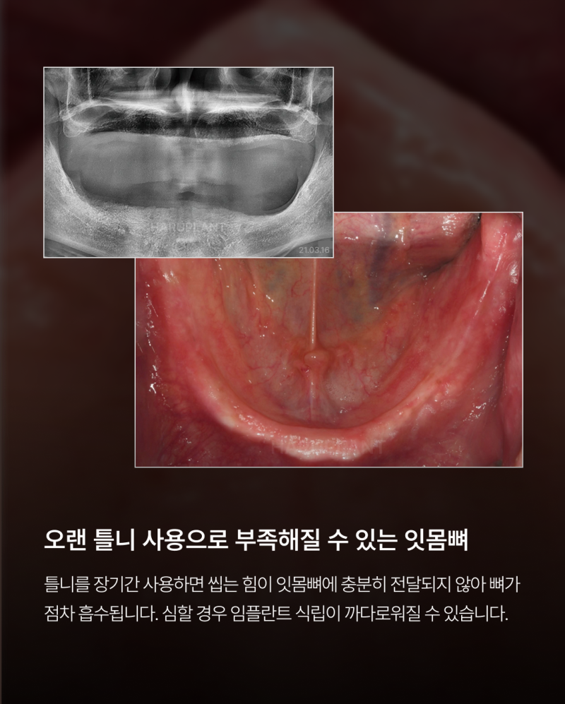 오랜 틀니 사용 후 전체 임플란트가 가능한 경우, 임플란트 종류와 전체 임플란트 뜻까지