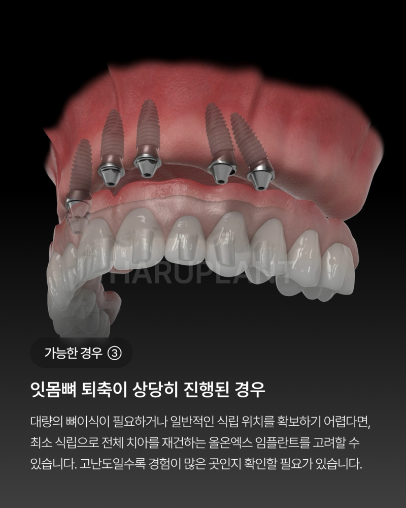 오랜 틀니 사용 후 전체 임플란트가 가능한 경우, 임플란트 종류와 전체 임플란트 뜻까지 사진 5