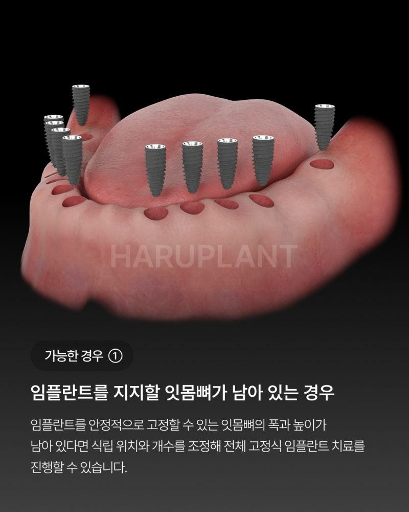 오랜 틀니 사용 후 전체 임플란트가 가능한 경우, 임플란트 종류와 전체 임플란트 뜻까지 사진 3