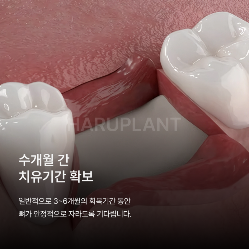 뼈이식임플란트 전 이런 점이 궁금하셨나요? 뼈이식임플란트과정과 기간, 통증까지 정리해드립니다 사진 7