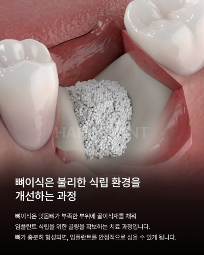 뼈이식임플란트 전 이런 점이 궁금하셨나요? 뼈이식임플란트과정과 기간, 통증까지 정리해드립니다 사진 4