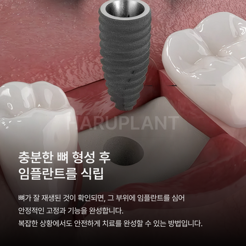 뼈이식임플란트 전 이런 점이 궁금하셨나요? 뼈이식임플란트과정과 기간, 통증까지 정리해드립니다 사진 8