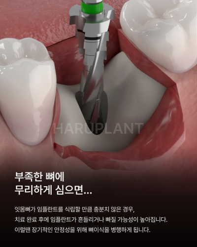 뼈이식임플란트 전 이런 점이 궁금하셨나요? 뼈이식임플란트과정과 기간, 통증까지 정리해드립니다 사진 3