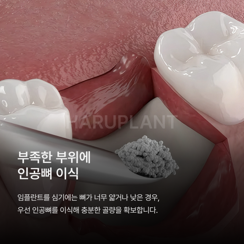 뼈이식임플란트 전 이런 점이 궁금하셨나요? 뼈이식임플란트과정과 기간, 통증까지 정리해드립니다