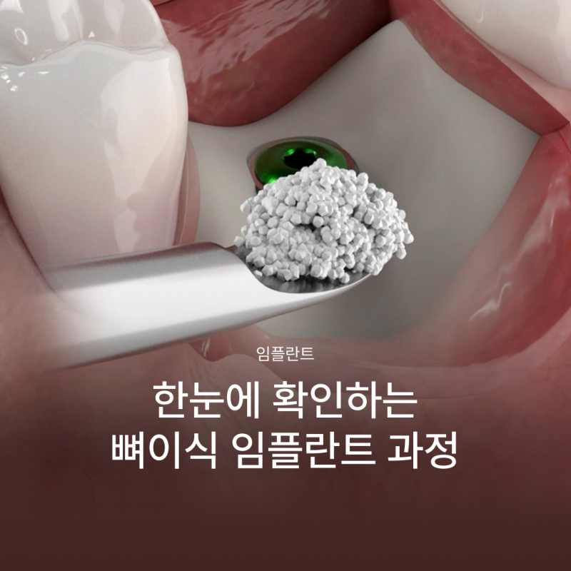 뼈이식임플란트 전 이런 점이 궁금하셨나요? 뼈이식임플란트과정과 기간, 통증까지 정리해드립니다