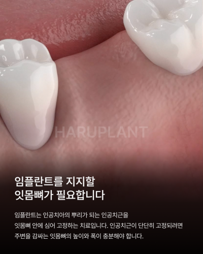 뼈이식임플란트 전 이런 점이 궁금하셨나요? 뼈이식임플란트과정과 기간, 통증까지 정리해드립니다 사진 2