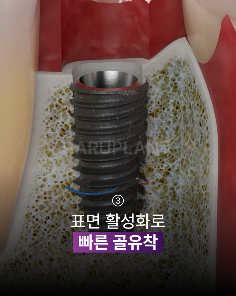 임플란트기간을 줄이고 싶다면? 빠른 회복으로 주목받는 플라즈마 임플란트, 후기까지 알아보세요! 사진 5